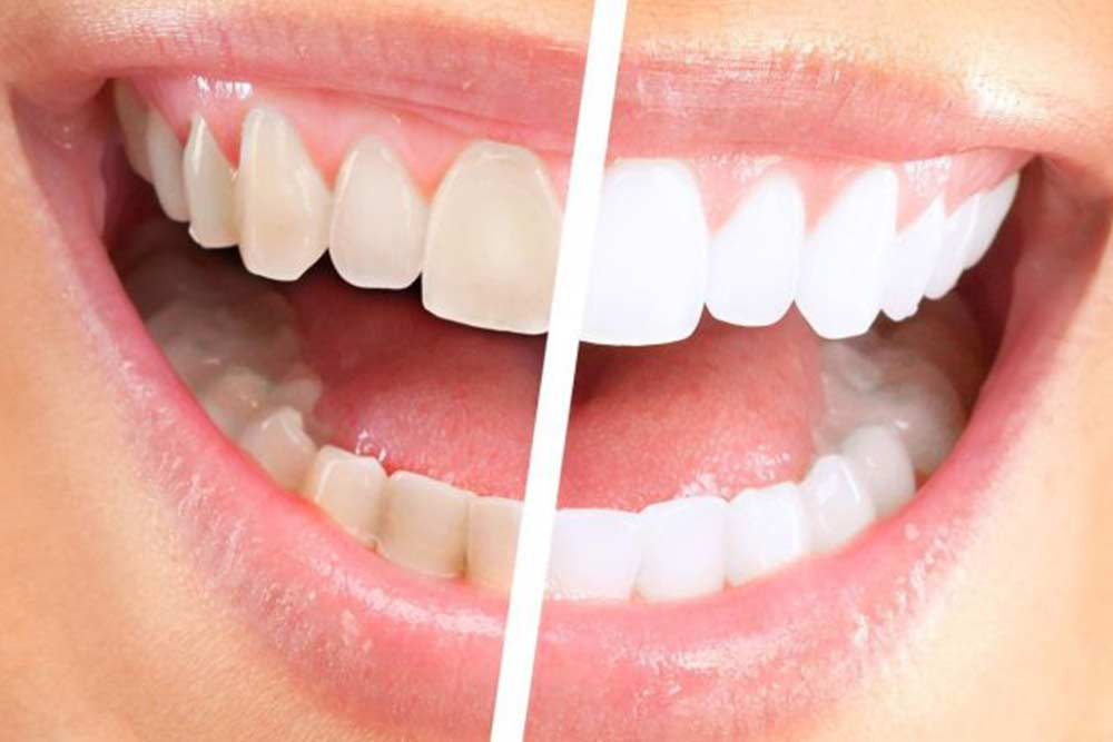 Sbiancamento Dentale Professionale